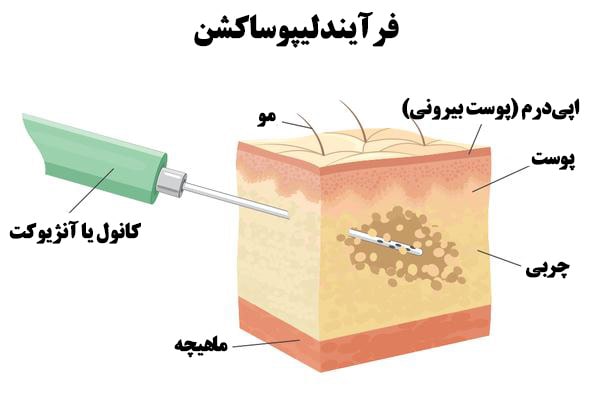 جزئیات روش درمانی تزریق چربی