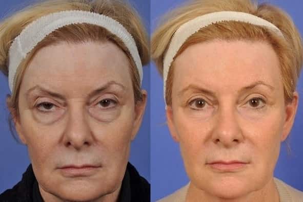 بلفاروپلاستی