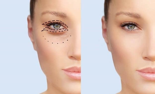 روش عمل جراحی پلک