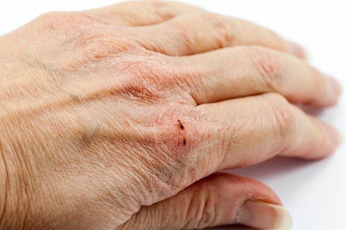 خشکی پوست دست نشانه چیست؟ راه های درمان خشکی پوست دست