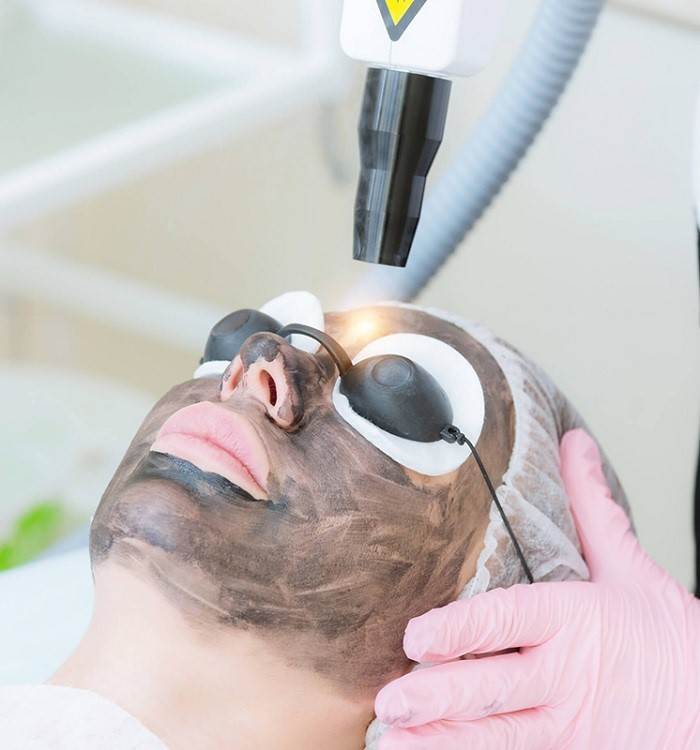 لیزر برای پیلینگ پوست