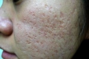 اسکارهای غلطکی (rolling) و واگنی (box)