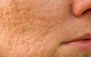 اسکارهای پیوسته (tethered)