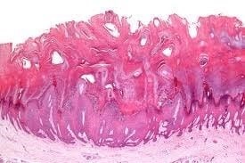 علائم زگیل تناسلی