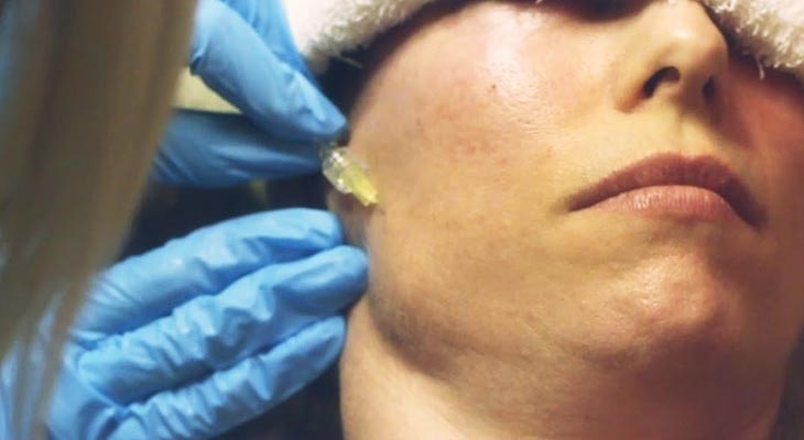 ظاهر جوان با کربوکسی تراپی